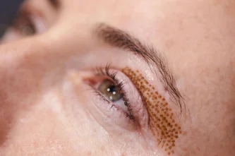Blefaroplastia Plexr sin cirugía: rejuvenece tu mirada en Estambul