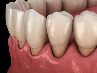 Gencives qui se rétractent : comprendre la récession gingivale et agir