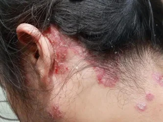 Psoriasis del cuero cabelludo: comprensión, tratamiento y control de los síntomas