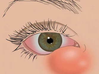 Dites adieu aux yeux larmoyants : traitements efficaces de la dacryocystite