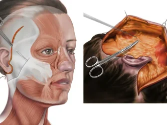 Deep Plane vs SMAS Facelift: Which Technique Actually Delivers Better Results?