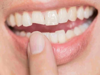 Broken or Chipped Teeth: Expert Repairs & Restoration Options