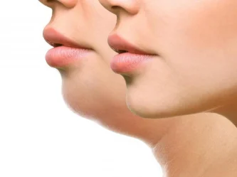 كيف تتخلص من الذقن المزدوج؟ أفضل العلاجات لتحديد خط الفك