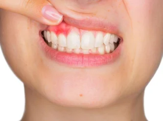 ناسور الأسنان: الأسباب والأعراض والعلاج - ومتى تحتاج إلى طبيب فورًا؟