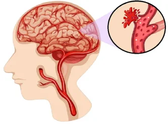 نزيف الدماغ: الأسباب والأعراض والعلاج الحاسم