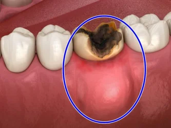 Dental abscess: how to cure it?