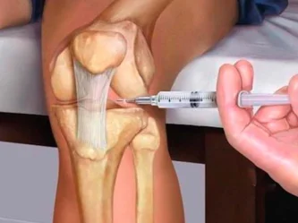 Infiltración de rodilla para la artrosis: alivio del dolor y recuperación de movilidad