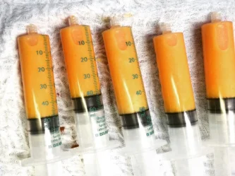 Les mille usages de la greffe de graisse (lipofilling)