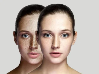 Láser antimanchas: la solución definitiva para eliminar imperfecciones de la piel