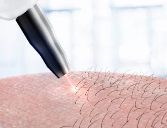 Laser Titanium : l'épilation définitive nouvelle génération en Turquie