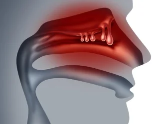 Polypes nasaux : symptômes, diagnostic et solutions de traitement