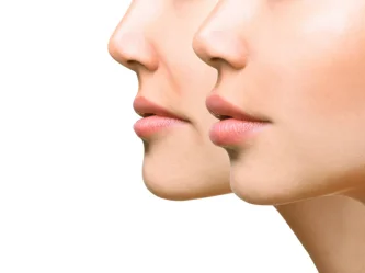 Volumétrie du visage : guide complet pour redonner du volume en douceur