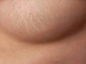 علامات التمدد على الثديين | الأسباب الشائعة والحلول التجميلية