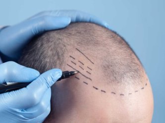 زراعة الشعر في تركيا 2026: لماذا تظل تركيا الوجهة ..