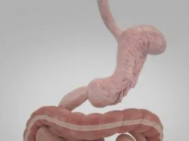 عملية طي المعدة بالمنظار المعلومات والأسعار عملية طي المعدة بالمنظار
