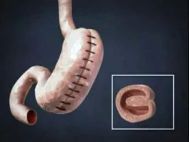 تراكب المعدة المعلومات والأسعار تراكب المعدة