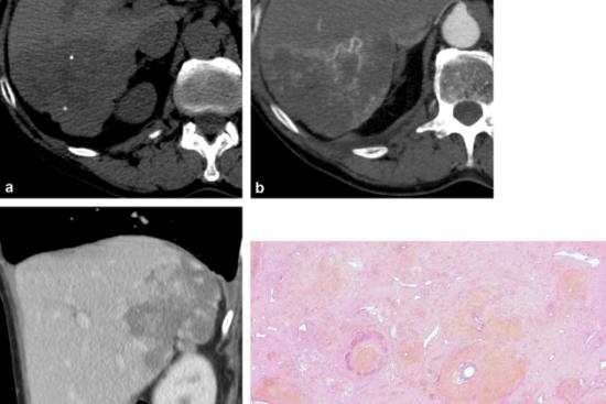 Surgery of hepatic hemangioma