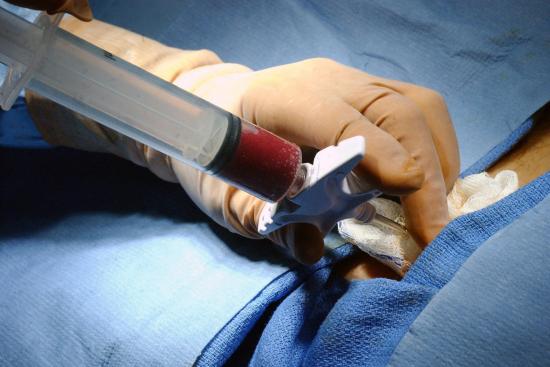 Transplante de médula osea