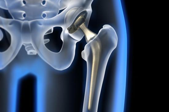 Hip replacement prosthesis