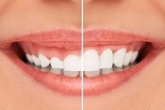 Crown lengthening