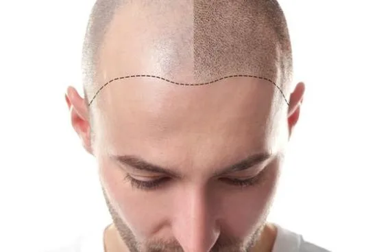 زراعة الشعر
