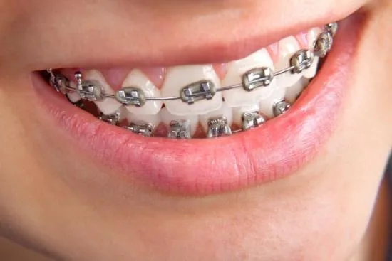 Braces