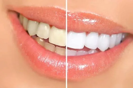 Teeth whitening