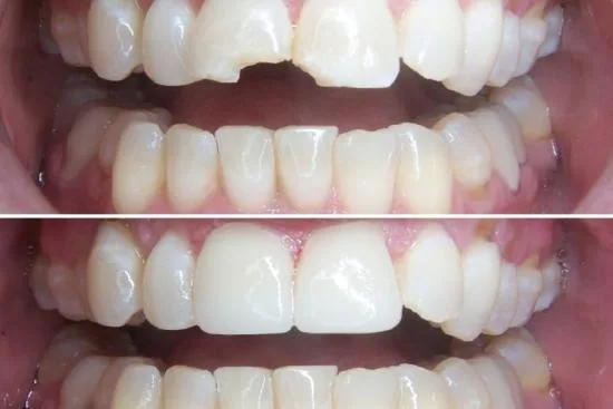 Tooth crown