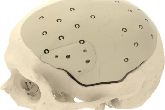 Cranioplastia Cranioplastia