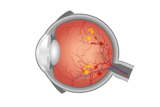 Tratamiento de la retinopatía diabética