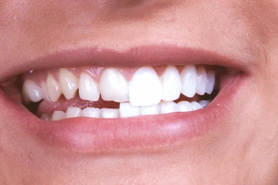 Dental veneers