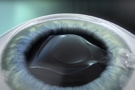 Implantes fáquicos ICL