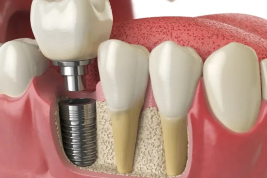 Immediate loading of dental implants