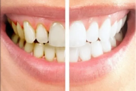 Laminate veneers