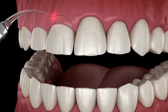 Gingivectomie
