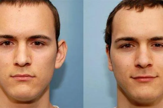تجميل الأذن البارزة تجميل الأذن البارزة