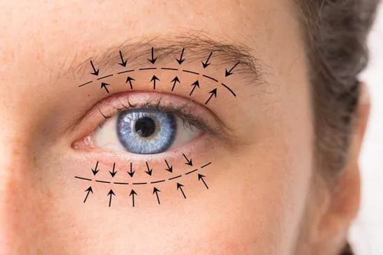 Blefaroplastia