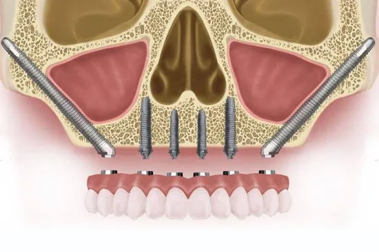 Zygomatic implants