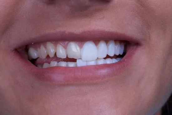 Zirconium veneers