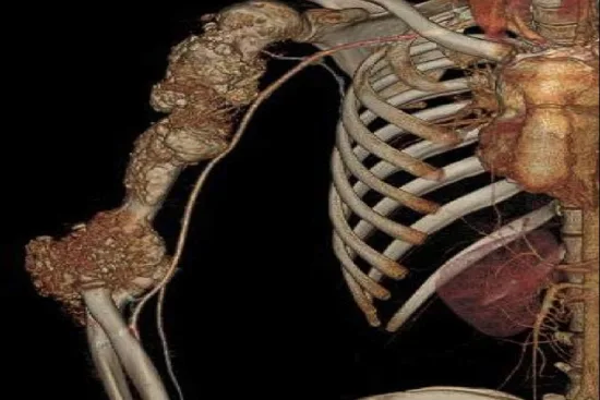 Bone cancer treatment Turkey