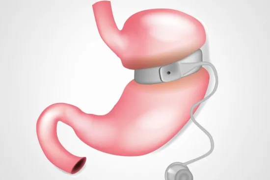 Bariatric surgery Turkey Bariatric surgery Turkey