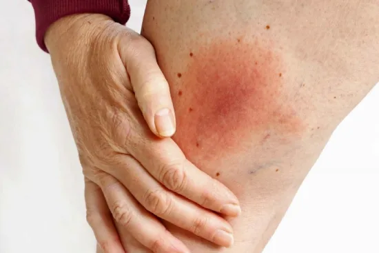 Lyme disease Turkey Lyme disease Turkey