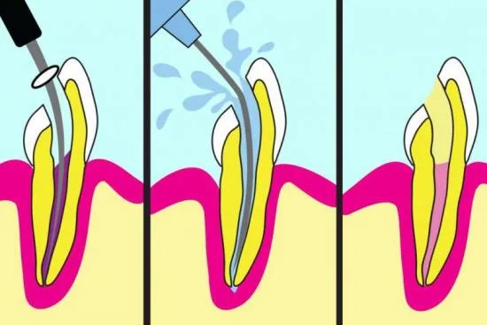 Dental root canal treatment Turkey Dental root canal treatment Turkey