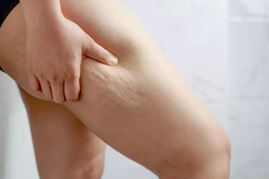 Cirugía del lipedema