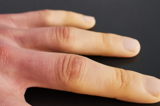 Tratamiento de la esclerodermia