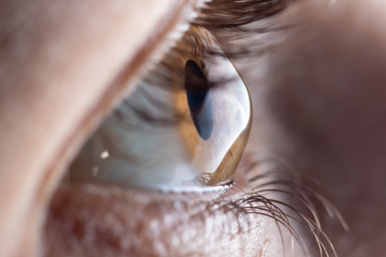 Keratoconus treatment