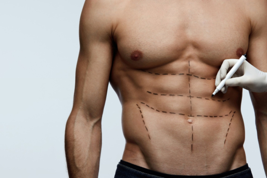 Abdominal Etching Abdominal Etching