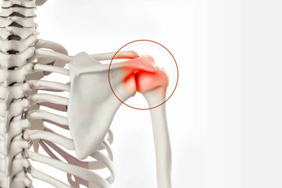 Treatment of the subacromial shoulder impingement