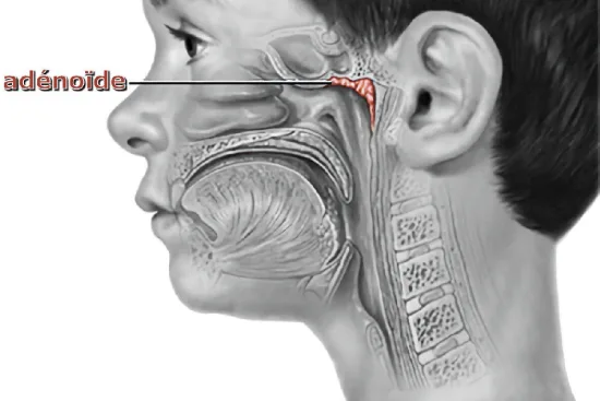 Causas de la hipertrofia adenoidea 2026 Causas de la hipertrofia adenoidea 2026