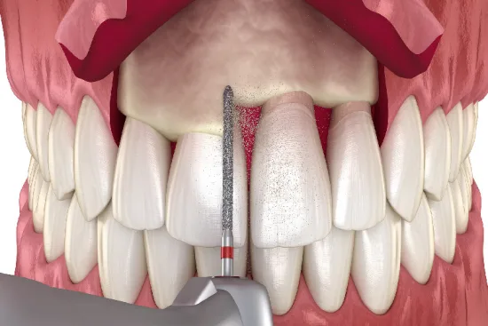 Who can benefit from coronal elongation? 2026 Who can benefit from coronal elongation? 2026